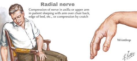Saturday Night Palsy Compression of Radial nerve in ... | GrepMed