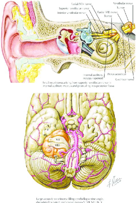 Acoustic neuroma and its relationship to nerves and vessels. (Netter ...