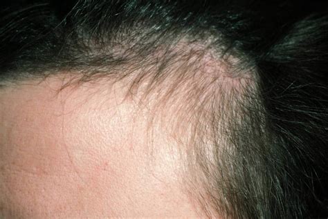 Hair Loss In Women & Men - Causes, Diagnosis & Hair Loss Treatment