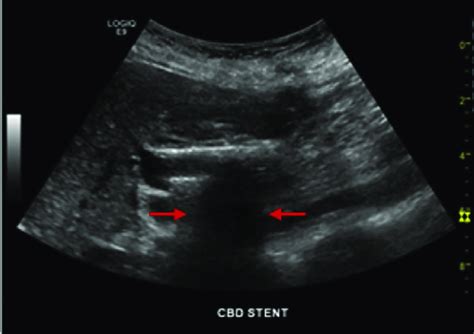 US image showing the indwelling common bile duct (CBD) stent with... | Download Scientific Diagram