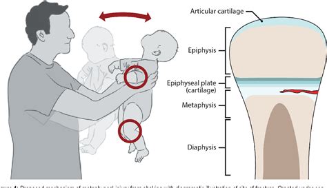 Figure 1 from Are There Hallmarks of Child Abuse? I. Osseous Injuries | Semantic Scholar