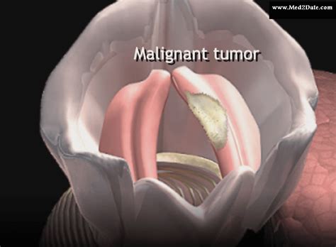 Cancer larynx: causes, symptoms, stages, diagnosis, treatment