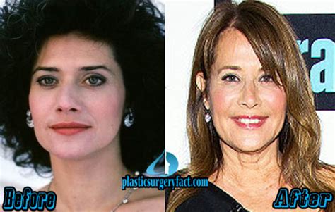 Lorraine Bracco Plastic Surgery Before and After