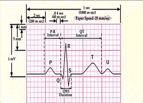 How to read an ECG – Physical Therapy Reviewer