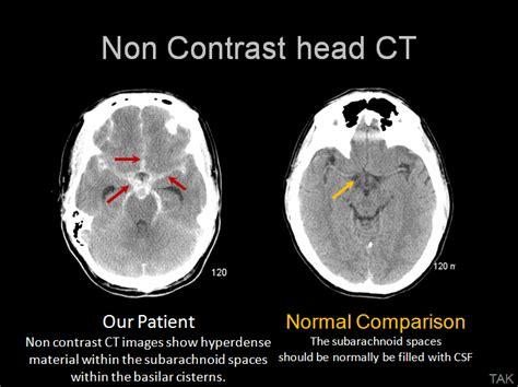 CASE 3: Imaging Discussion - Neuroradiology