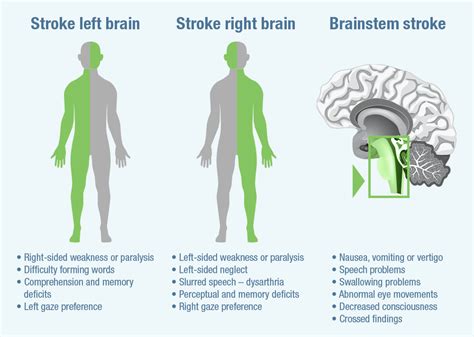 Acute ischaemic stroke symptoms and mimics | strokeforum.com | Stroke symptoms, Swallowing ...