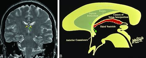 Fornix Brain Mri