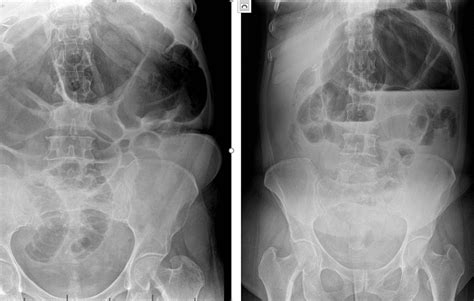 Cecal Volvulus a Rare Cause of Intestinal Obstruction. A Case Report ...