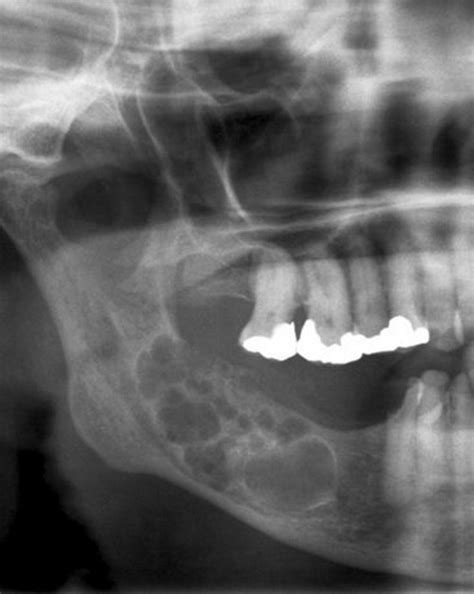 AMELOBLASTOMA | Buyxraysonline