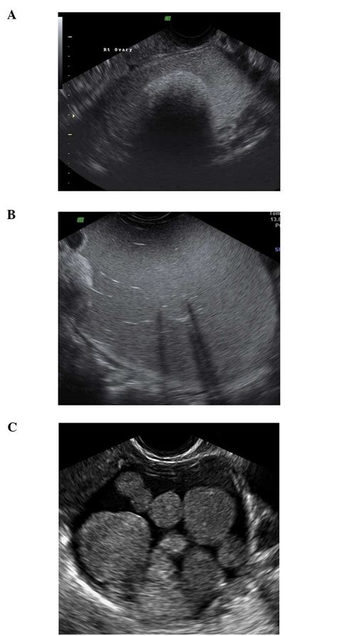 - Ultrasound features of dermoid cysts. (A) Rokitansky nodule with a strong acoustic shadow. (B ...