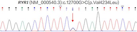 Exome sequencing revealed a point mutation (amino acid change) on the ...