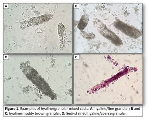 Urine Sediment of the Month: Mixed, Acellular Casts - Renal Fellow Network