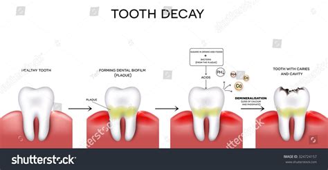 Tooth Decay Formation Step By Step Stock Vector (Royalty Free ...