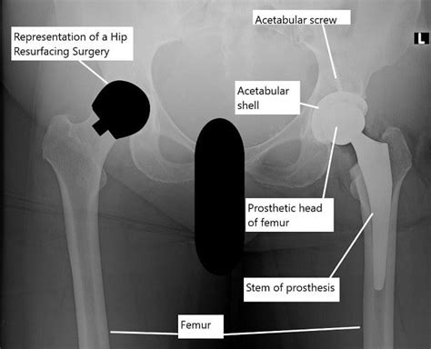 Hip Resurfacing vs Total Hip Replacement | Complete Orthopedics