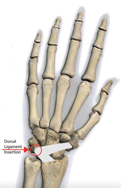 Avulsion Fractures of the Triquetrum – Fife Virtual Hand Clinic