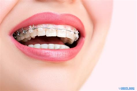 Sapphire Braces. Orthodontics in Barcelona | Diente Sano - Dental clinic in Barcelona