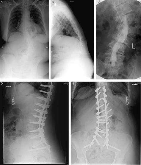 Adult degenerative scoliosis insights, challenges, and treat ...