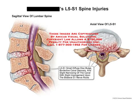 AMICUS Illustration of amicus,injury,lumbar,sacral,spine,L5-S1,diffuse ...