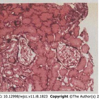 Renal biopsy results. Biopsy revealed mild glomerular mesangium and... | Download Scientific Diagram