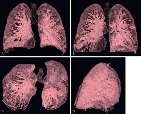 Lung Anatomy Netter Google Search Lung Anatomy Human - vrogue.co