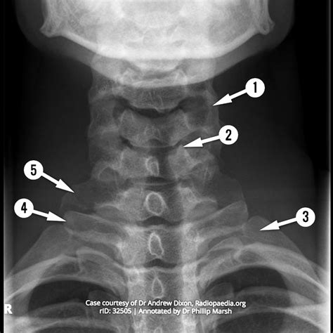 Cervical Vertebrae Anatomy Quiz | The Best Porn Website