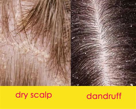 What Is Dandruff Differences Between Dandruff Vs Dry Scalp | My XXX Hot ...