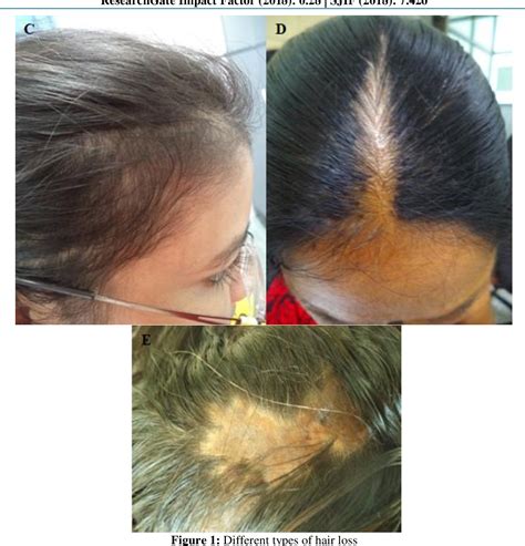 [PDF] A Clinical Study of Diffuse Hair Loss in Women in Tertiary Care Hospital | Semantic Scholar