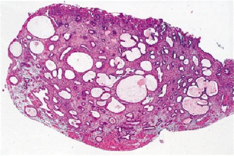 Endometrial Hyperplasia Histology