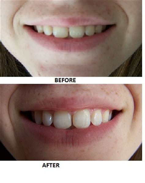 Crest 3D White Whitestrips Intensive Professional Effects reviews in Teeth Whitening - ChickAdvisor