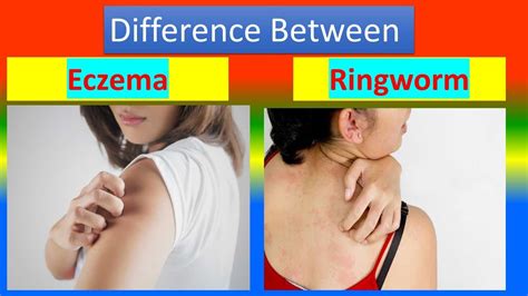 Difference between Eczema and Ringworm - YouTube