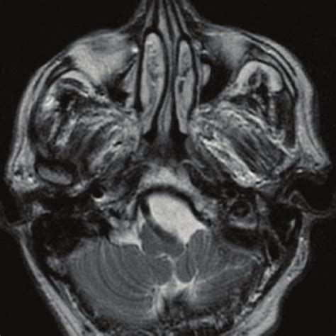 (PDF) Medulla compression caused by vertebrobasilar dolichoectasia