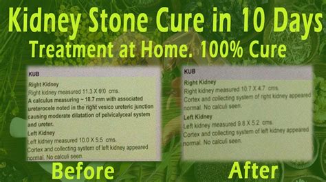 kidney stones natural treatment in tamil | kidney stones treatment at home in tamil - YouTube