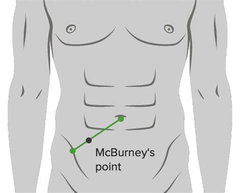 Appendicitis | Concise Medical Knowledge