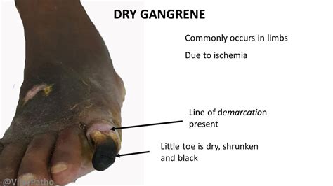 PATHOLOGY OF GANGRENE | Pathology Made Simple