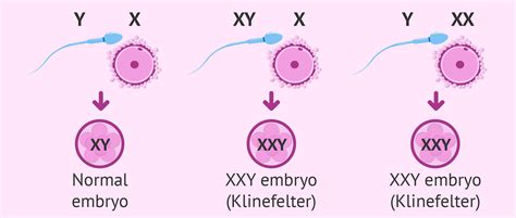 Klinefelter Syndrome Xxy Syndrome Symptoms Causes Fertility | The Best Porn Website