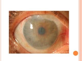 Corneal edema after cataract surgery | PPT