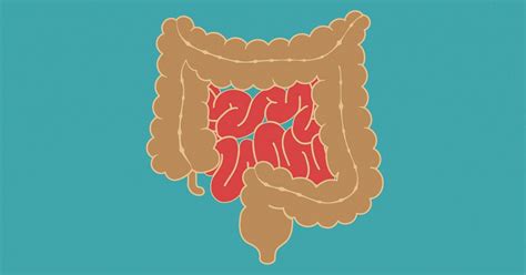 Small Intestine Cancer: Symptoms, Types, and Treatment