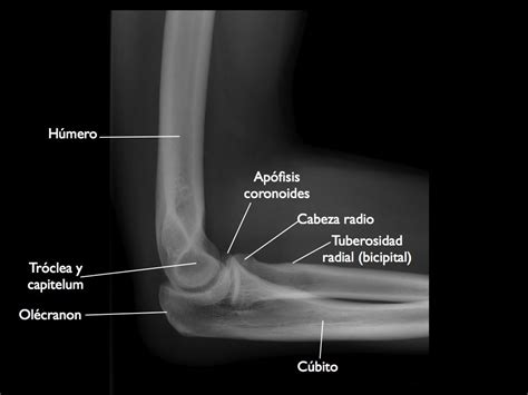 LAS FRACTURA DEL CODO - Cirugia de Columna en Matamoros