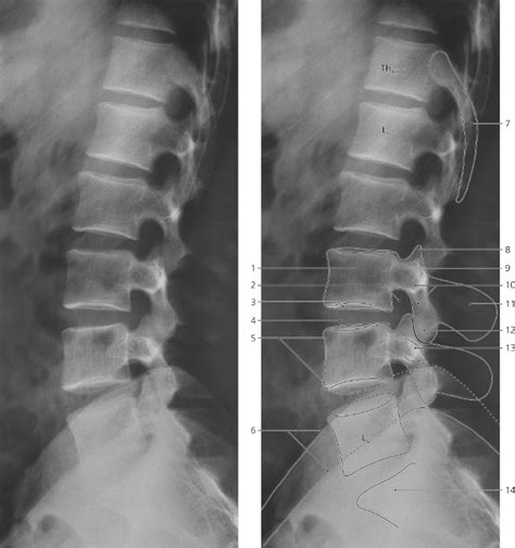 Spine | Radiology Key