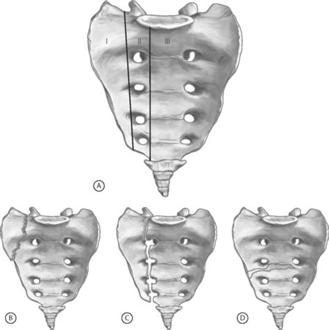 Sacral Insufficiency Fractures | Musculoskeletal Key