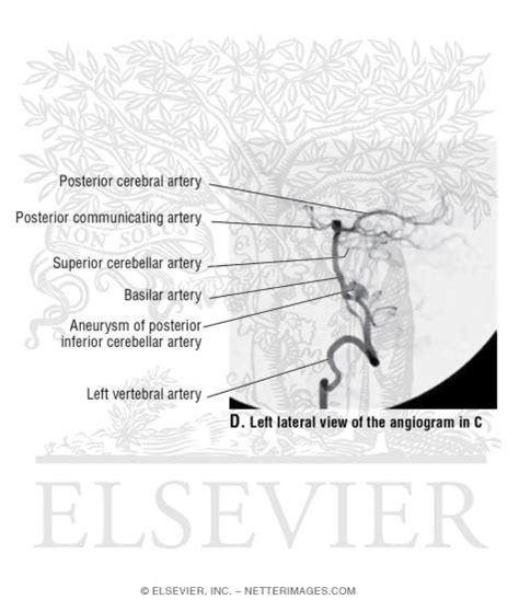 Left Lateral View of a Digital Catheter Angiogram of the Left Vertebral ...