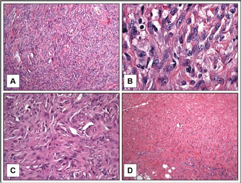 Malignant Spindle Cell Neoplasm Prognosis