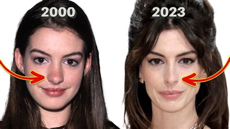 Anne hathaway’s before and after denies nose job lorry hill – Artofit