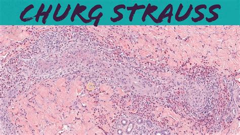 Churg-Strauss syndrome (eosinophilic granulomatosis with polyangiitis ...