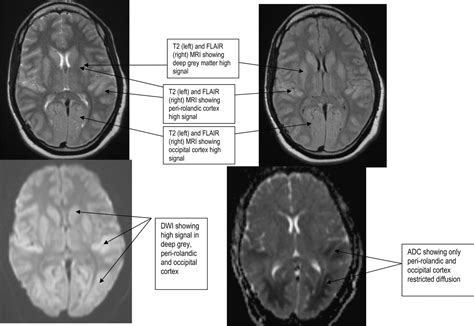 Hypoxic-ischaemic brain injury | Practical Neurology