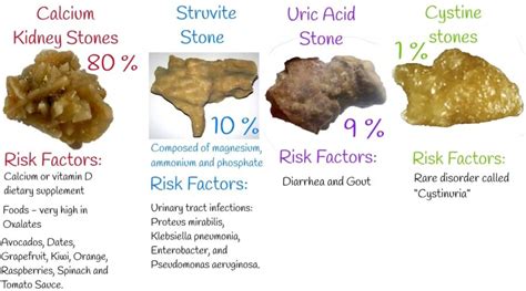 Urinary / Kidney Stone Treatment – Dr. Rajesh Dhake