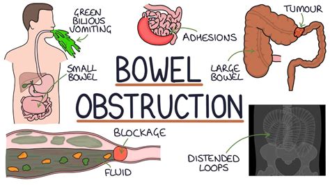 Understanding Bowel Obstruction - YouTube