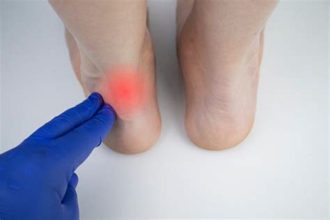 Achilles Heel Pain: Causes, Treatment and FAQs