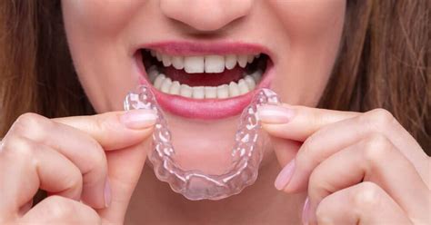 How to Straighten Teeth at Home With Aligners and DIY Kits