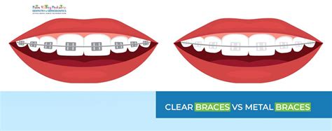 Clear Braces vs Metal Braces Pros & Cons: Comparison Guide